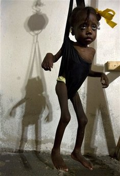 children malnutrition haiti